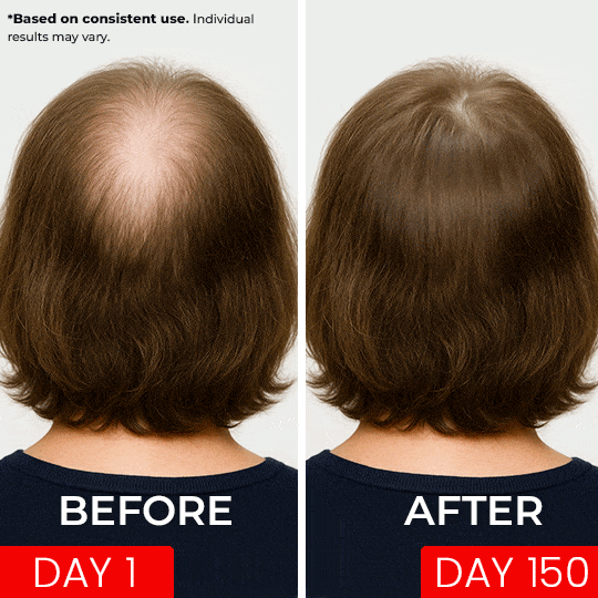 Red Light Therapy Hat - Regrow Hair Lost to Hormonal Imbalance
